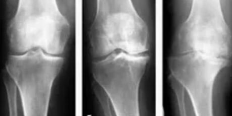 Gonarthrose 3 graden