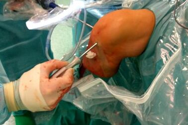 Chirurgische interventie voor artrose