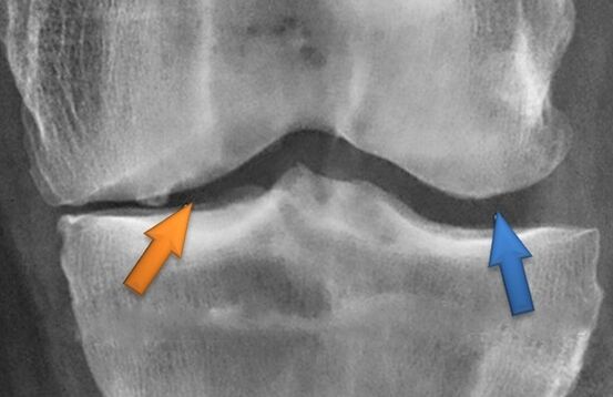 Kinesitherapie voor artrose