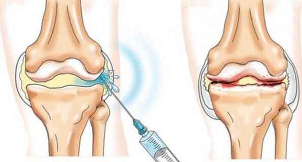 Medische maatregelen voor artrose